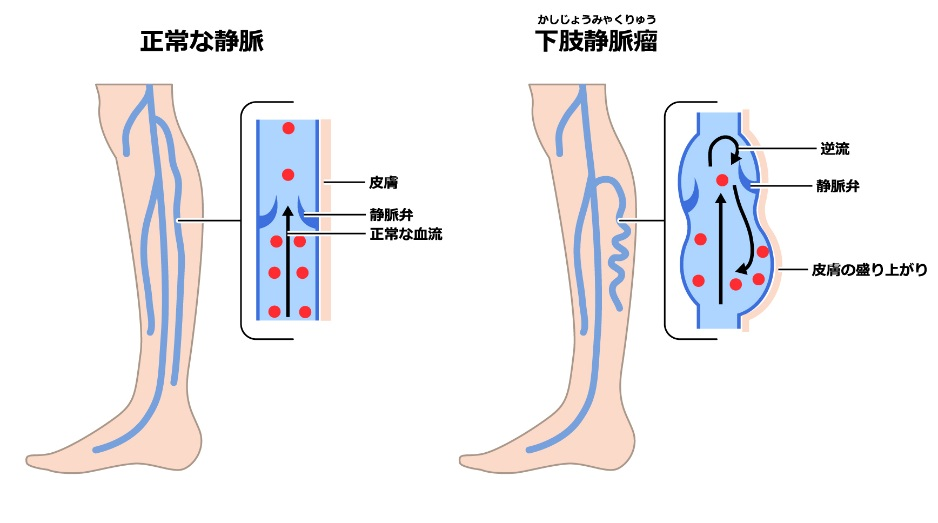 下肢静脈瘤