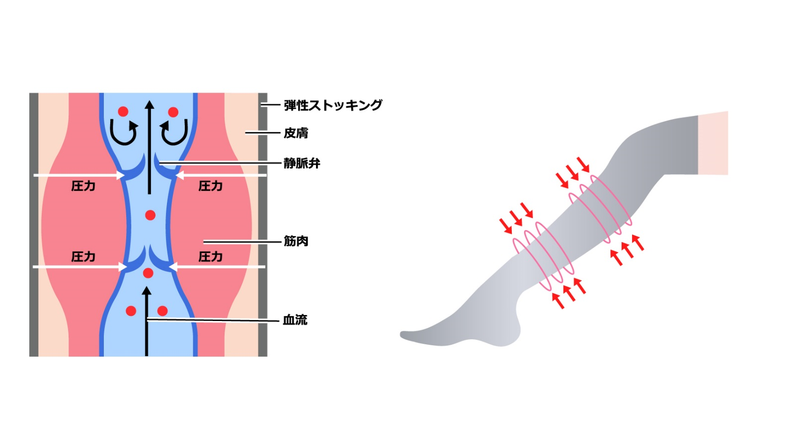 下肢静脈瘤